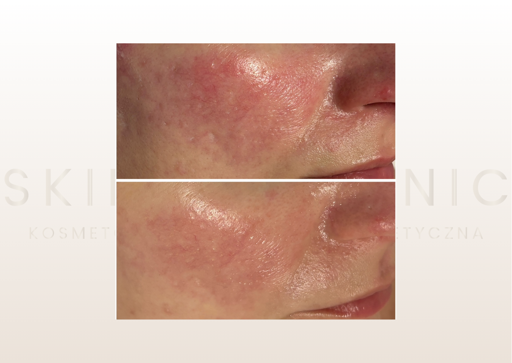 Trądzik różowaty / rumień