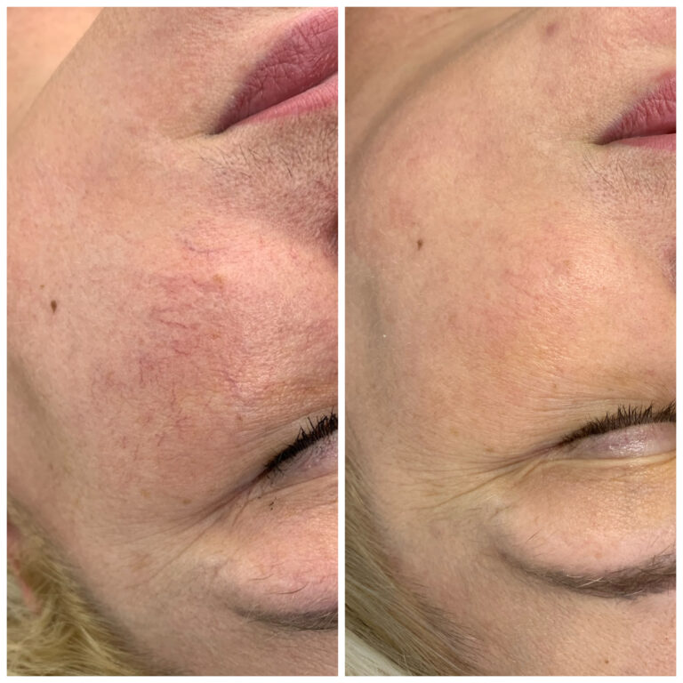 Efekt zabiegu w Skinset Clinic – zdjęcie przed i po 2