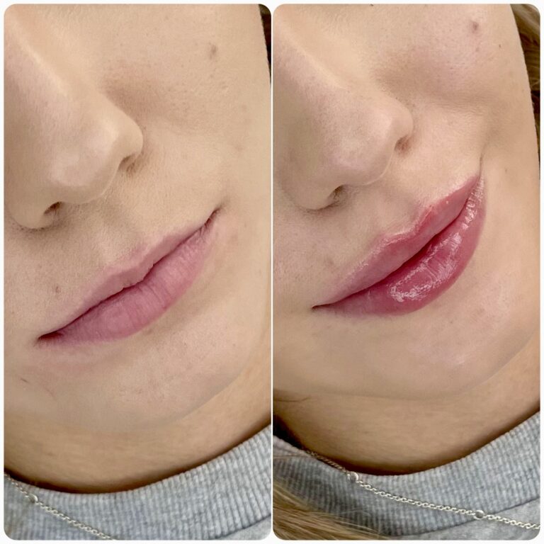 Efekt zabiegu w Skinset Clinic – zdjęcie przed i po 9