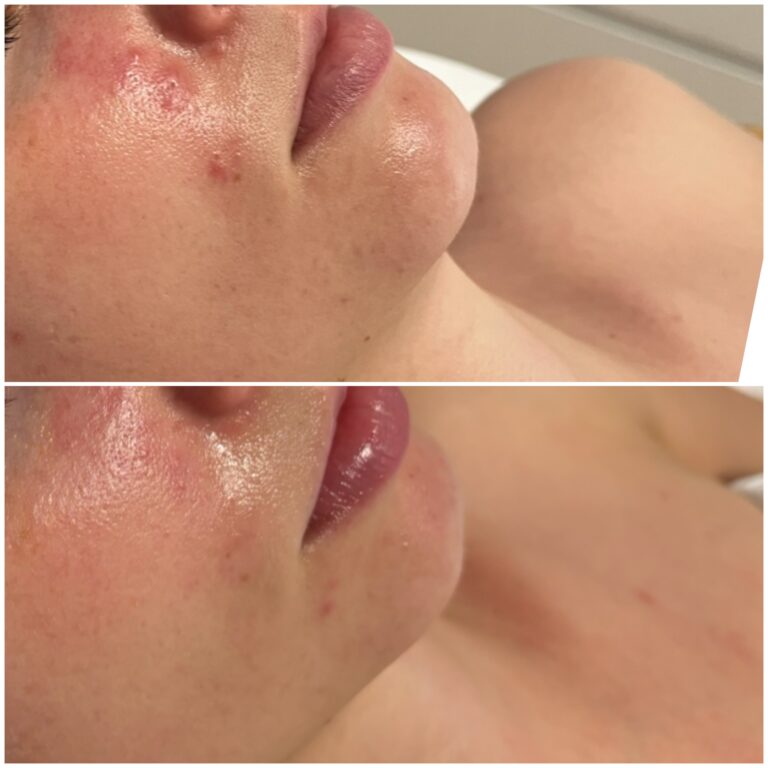 Efekt zabiegu w Skinset Clinic – zdjęcie przed i po 7