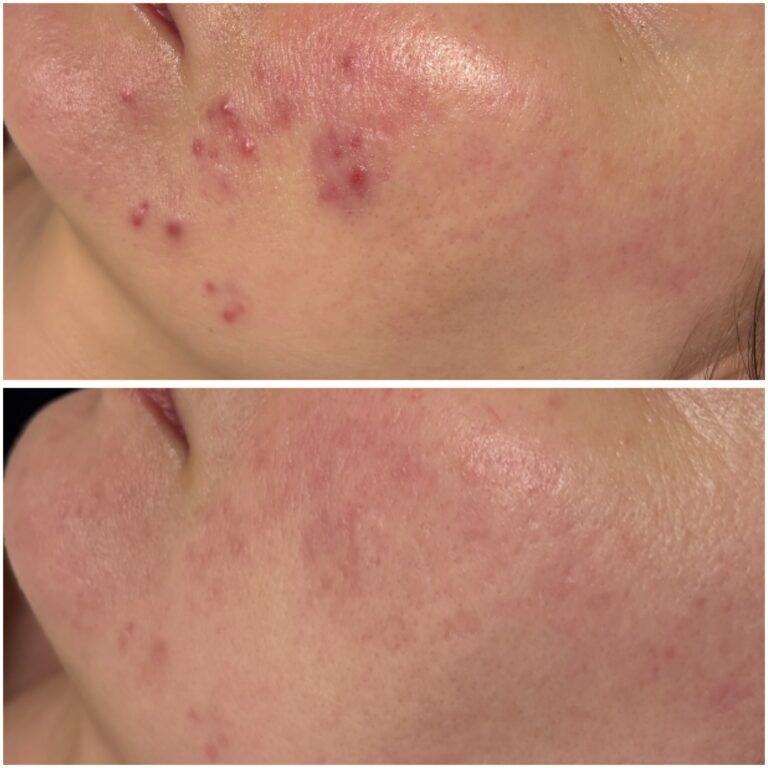 Efekt zabiegu w Skinset Clinic – zdjęcie przed i po 5