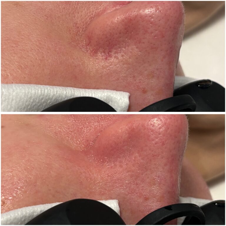 Efekt zabiegu w Skinset Clinic – zdjęcie przed i po 3