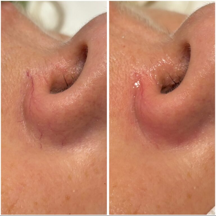 Efekt zabiegu w Skinset Clinic – przed i po