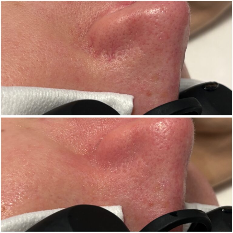 Efekt zabiegu w Skinset Clinic – przed i po