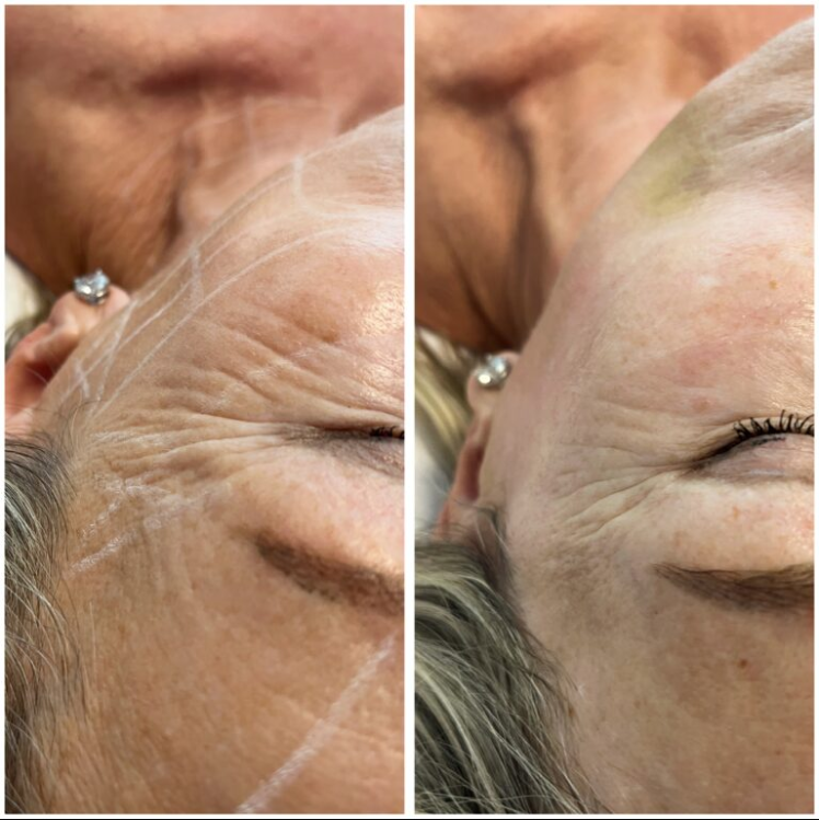 Efekt zabiegu w Skinset Clinic – przed i po