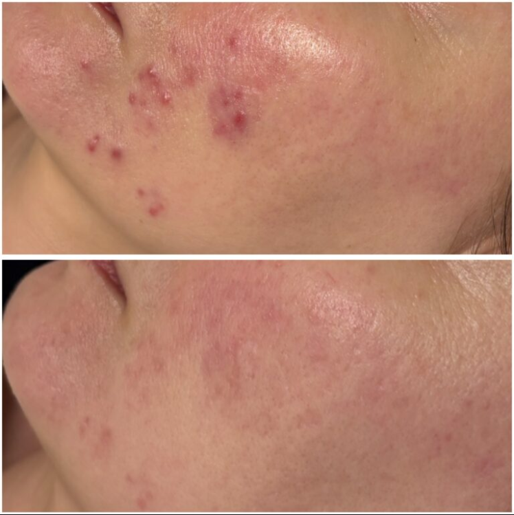 Efekt zabiegu w Skinset Clinic – przed i po