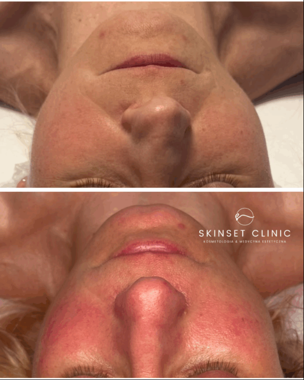 Efekt zabiegu w Skinset Clinic – przed i po