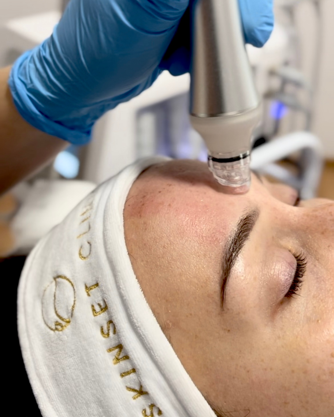 Oczyszczanie wodorowe w Skinset Clinic