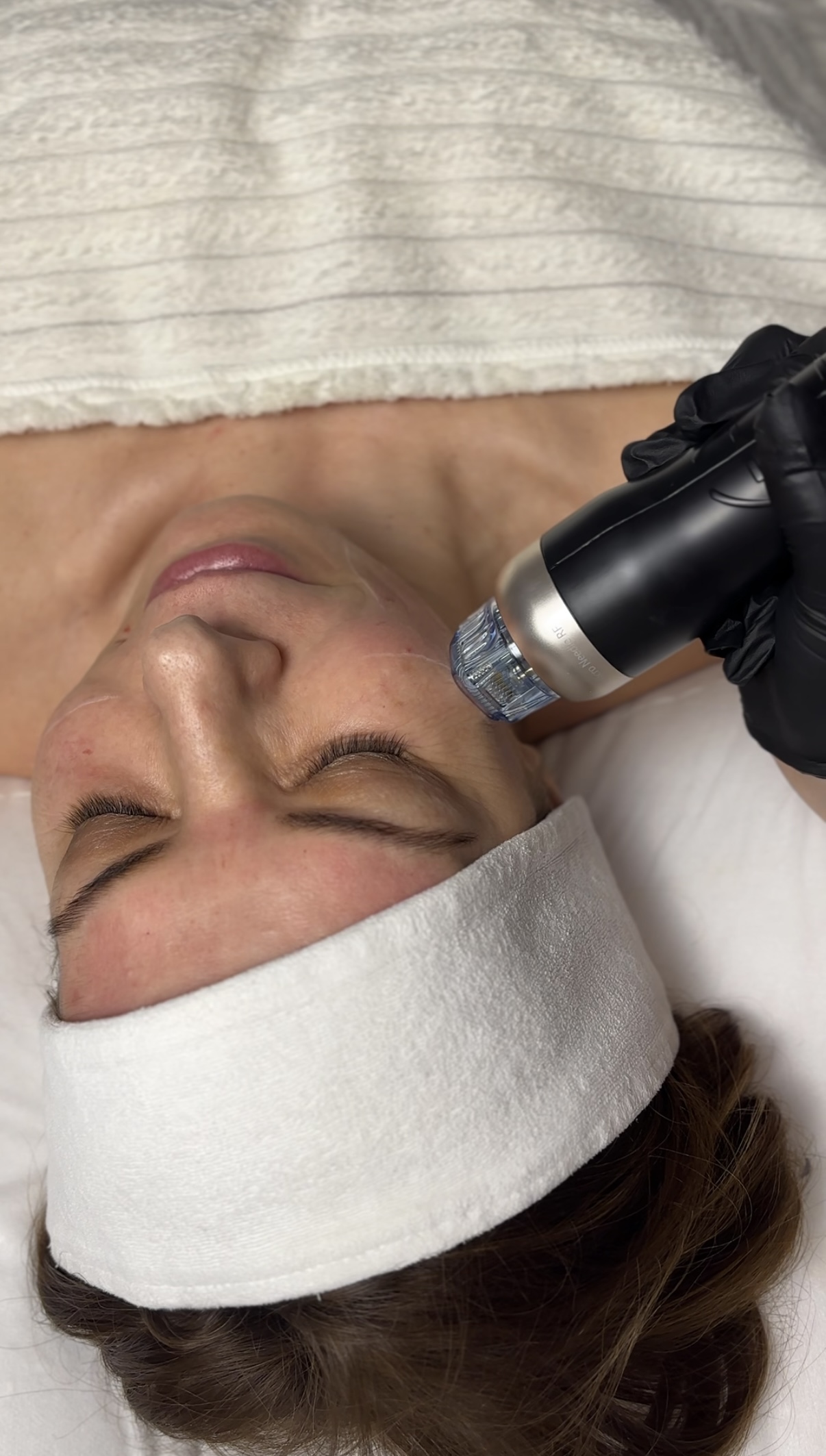 Radiofrekwencja mikroiglowa w Skinset Clinic