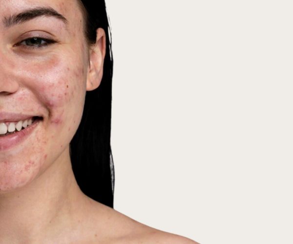 leczenie trądziku warszawa